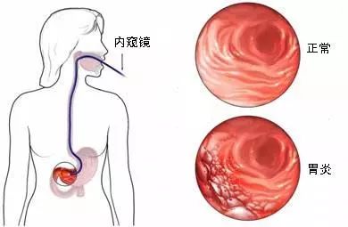 一枚小膠囊，看清你的胃！