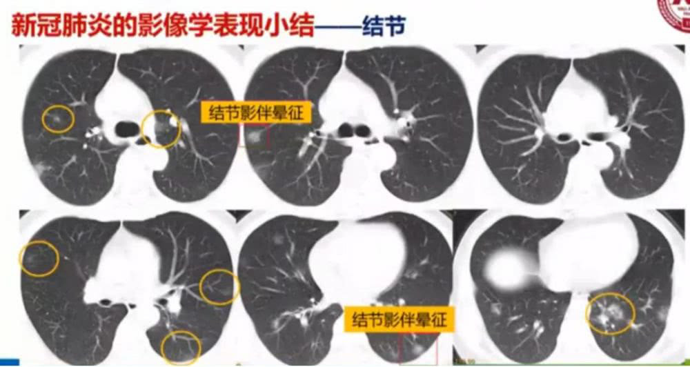 AI助力疫情防控，專利為其保駕護航！