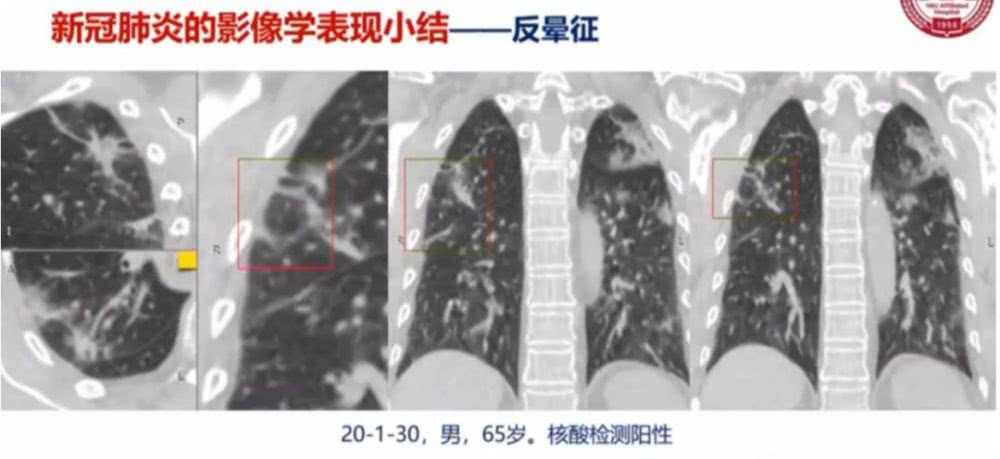 AI助力疫情防控，專利為其保駕護航！